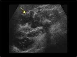 Renal Abscess Hypoechoic Complex Mass Thick Irregular Walls Shadowing Associated With Gas Formation Ultrasound Sonography Ultrasound Tech Ultrasound