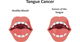 Image result for white cancer on tongue)