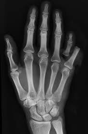 Image result for Volar PIP Dislocation