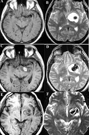 Cerebral (brain) aneurysms occasionally cause some of these symptoms as they start to swell ultrasound, magnetic resonance imaging (mri), and computed tomography (ct) scans can all. Aneurysm Presenting As Parkinsonism Neurology