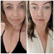 Reducing hooded eyes and crepey skin with collagen shots