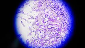 Experts hypothesize that a combination of factors linked to covid is fueling the surge. Black Fungus Treatment Runs Short In India As New Cases Of Infection Emerge Live Science