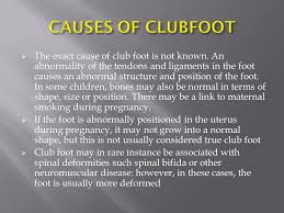 Common causes of club foot. Management Of Neglected Club Foot Ppt Video Online Download