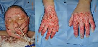 The cellulitis and abcess are the consequence of non healed burn area, and the reason for debridement. Bromelain Based Enzymatic Debridement As A Treatment Of Choice In High Risk Patient With Deep Facial Burns A Case Report Sciencedirect