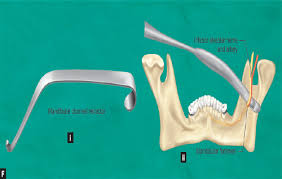If you have 1 or more missing teeth, your dentist may advise dental implants. Jaypeedigital Ebook Reader