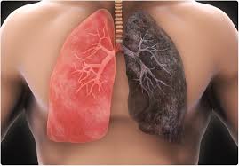 Based on the findings, the researchers estimated that lifetime risk of lung cancer by smoking status in males and females is: Non Smokers Who Develop Lung Cancer Are Hugely Disadvantaged Says Phe