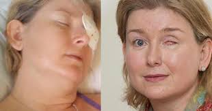 Đeo kính áp tròng, vi trùng đục thủng mắt