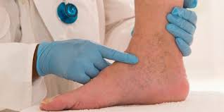 Chto Takoe Tromboz I Kak Ego Predotvratit Lajfhaker