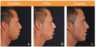 Unparalleled customer support to ensure you're supported every step of the way. Chin Augmentation Filler Versus Prosthesis The Pmfa Journal
