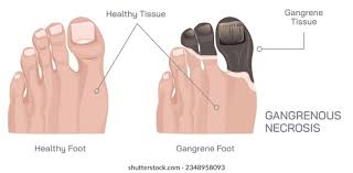 Image result for toe amputation