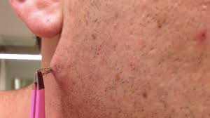Some ignorant person said it happens to only dirty people, well i think thats really silly as ingrown hairs affects a large percentage of africans and leads to bumps even if you bathe ten times a day! Watch This Man Pull Out The World S Longest Ingrown Hair And Try Not To Barf Forever