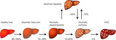 Recent Advances In Alcohol Related Liver Disease Ald Summary Of A Gut Round Table Meeting Gut