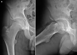 Image result for Hip Apophysitis