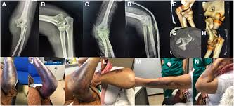 Image result for Elbow Dislocation