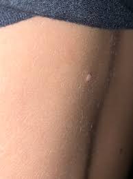 7 this dermatitis can be treated with emollients, and corticosteroids if needed. Molluscum Contagiosum Gbcn