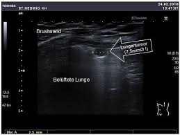 Pneumothoraces) refers to the presence of gas (often air) in the pleural space. Anwendung Des Ultraschalls Am Brustkorb Degum