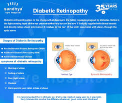 This means you may have had to wait longer than usual for your routine diabetic eye screening appointment. Diabetic Retinopathy Sandhya Eye Hospitals