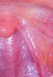 Image result for spinocellular carcinoma of the oral cavity