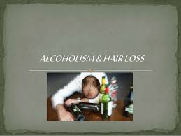 Hair loss due to alcohol consumption is mainly due to the fact that alcohol affects the levels of estrogen and zinc in the body, which subsequently affect hair growth. Hair Loss Due To Alcohol