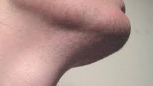 It's caused by an excess of male hormones called androgens. Unwanted And Excessive Hair In Women Steemkr