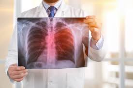After cancer is diagnosed, and a treatment plan has been decided on, doctors also use blood tests to monitor a patient's response to therapy. Revolutionary Blood Test Will Detect Stage 1 Lung Cancer Israel21c
