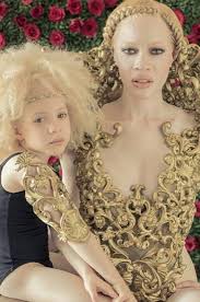 Image result for international albinism awareness day