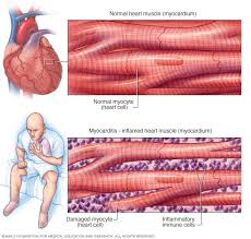 Myocarditis is a disease marked by the inflammation of the heart muscle known as the myocardium — the muscular layer of the heart wall. Myocarditis Symptoms And Causes Mayo Clinic