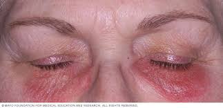 Image result for dermatitis contacta allergica