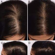 See more ideas about hair care, hair, hair treatment. Anti Hair Loss Home Care Set 1ampule Stamp Glombeauty Uae