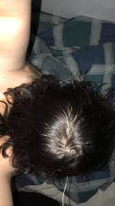 Am I Starting To Go Bald Im 19 And This Is The Top Of My Head Im Stressed Out About It Hair Beauty Skin Deals Me Fashion Going Bald Bald Head