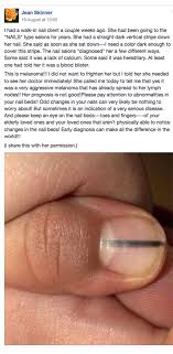 This disease is often referred to as, malignant melanoma of nail unit or nail unit melanoma. Please Pay Attention Woman Issues Warning About Unusual Cancer Symptom After Nail Technician Spots Her Melanoma
