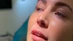 Video Kijk mee met een Lip Flip behandeling met Botox bij Kliniek ... - YouTube
