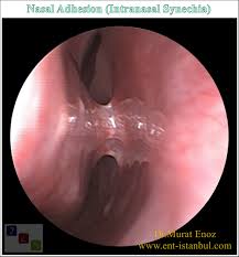 Many mammals, such as the dog, have a sagittal crest down the centre… Nasal Cavity Adhesion Synechia Definition Causes Symptoms And Treatment