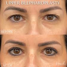 3 months post op from an Upper Blepharoplasty by Dr. Hosch & already the  results are phenomenal 🤩💫 #hoschtag #gethosched #hangingwithhosch