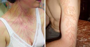 The study of planar lichtenberg figures along insulating surfaces and 3d electrical. These 19 People Were Struck By Lightning And What Happened To Their Skin Is Incredible