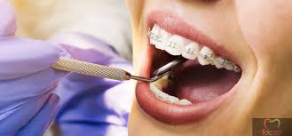 Check spelling or type a new query. 9 Hal Wajib Diketahui Sebelum Pasang Behel Gigi Fdc Dental Clinic
