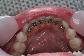 Image result for dental braces