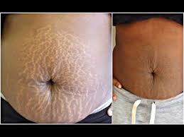 Remove Those Annoying Dark Patches On The Neck Underarms And Inner Thighs In 15 Minutes Youtube Lighten Stretch Marks Anti Aging Skin Products Stretch Marks