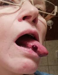 Image result for Puchýře na jazyku