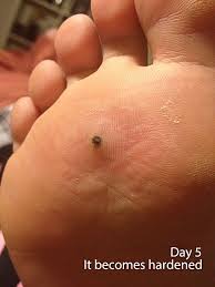 Since plantar warts are not dangerous, you can start your plantar wart removal at home, with natural remedies. Pin On Health Fitness