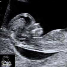 There was some confusion because my last period was about december 26 of 2013, but the first week of xxxxxxx i had a very short period and only bled one day. Nuchal Translucency Scan 12 Week Scan Down S Syndrome Screening