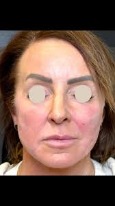 There is nothing wrong with investing in yourself! This beautiful lady has  done just that with consistent treatments over time. When you look better  than you did years ago, you have more confidence ...