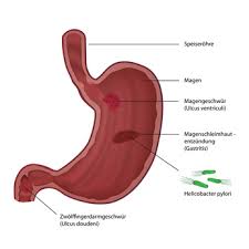 Thus there is a sharp burning pain in the upper. Akute Gastritis Ursachen Beschwerden Therapie Gesundpedia De