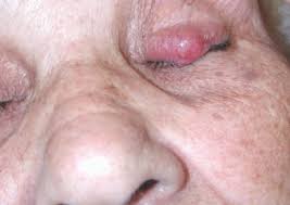 Merkel cell carcinoma typically affects older adults and the tumour usually starts in a sun exposed area such as the head or neck. Q A With Dr Paul Nghiem The Skin Cancer Foundation