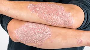 Image result for psoriasis