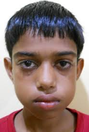 Cherubism with multiple dental abnormalities: a rare presentation.