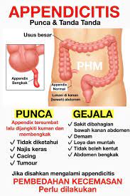 Stres bisa datang kapan saja, di antara kesibukan dan juga kecemasan anda. Public Health Malaysia Sekiranya Anda Disahkan Mengalami Appendicitis Rawatannya Utamanya Adalah Pembedahan Kecemasan Selain Antibiotik Sekiranya Tidak Dilakukan Apendiks Yang Sedang Membengkak Boleh Pecah Dan Kuman Dari Jangkitan Apendiks Akan