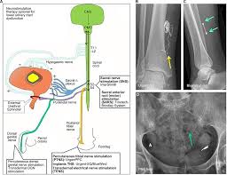 Full Text Clinical Utility Of Neurostimulation Devices In The Treatment Of Overa Mder