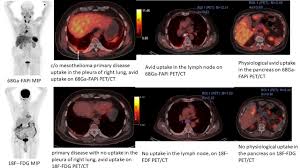 Maybe you would like to learn more about one of these? 68ga Data Fapi 05 Biodistribution And Comparison With 18f Fdg Pet Ct In Various Cancers Journal Of Nuclear Medicine