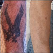 Treatment of tattoos with pure epidermal sheet grafting. Laser Tattoo Removal Cheltenham Forever Clinic Cheltenham
